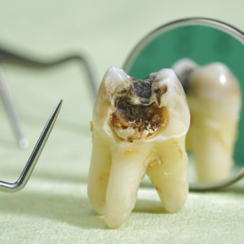 Dampak Konsumsi Alkohol pada Gigi- Global Estetik Dental Care