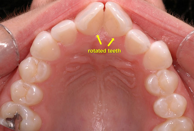 teeth rotated orthodontics smile ortho