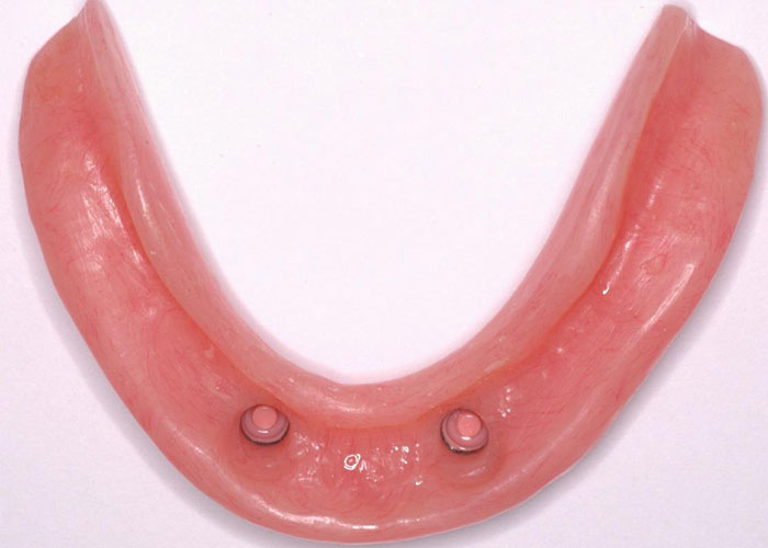 Fixed & Removable Dentures Gallery Williams Lake Smiles