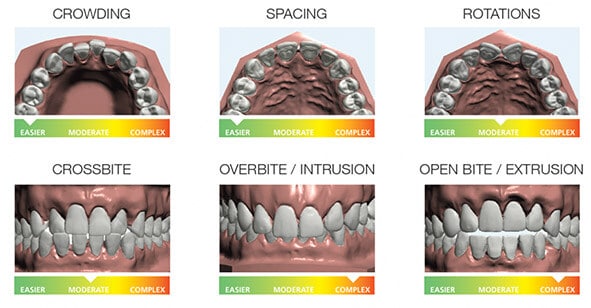 bite types