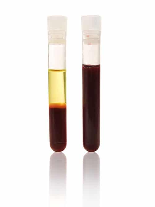 platelet rich plasma growing bone