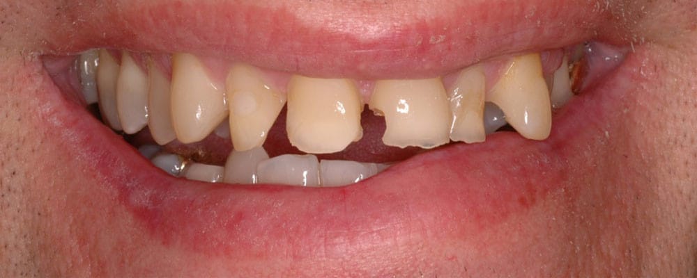 crowns and veneers 01 1000x400