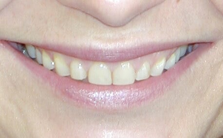 crowns and veneers 02 1