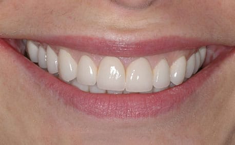 crowns and veneers 02 2