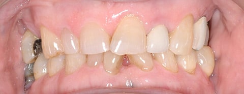 crowns and veneers 03 1