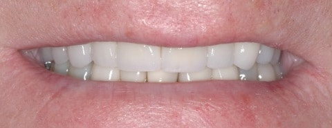 crowns and veneers 03 2