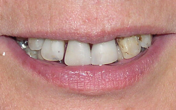 crowns veneers implants 01