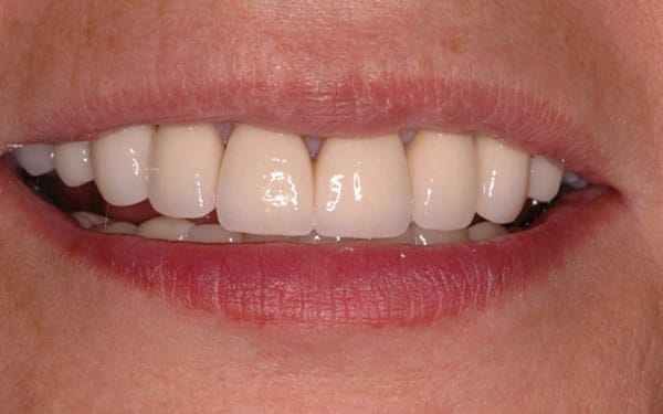 crowns veneers implants 03