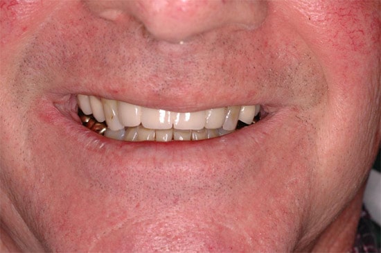 dental implant bridge after 1