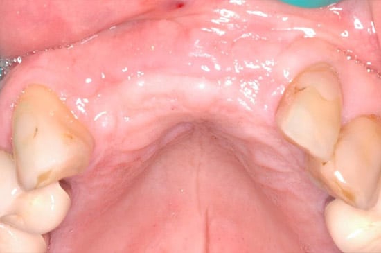 dental implant bridge before 1