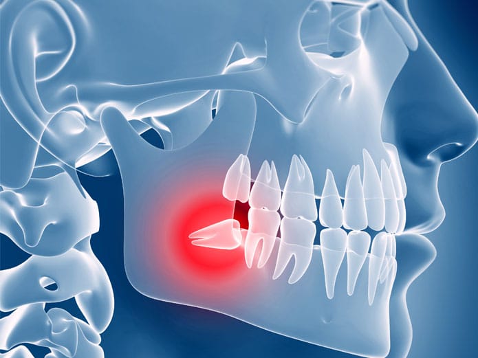 Wisdom Teeth Removal