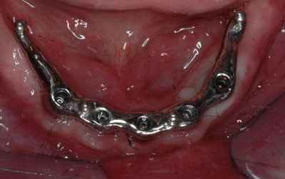 implant dentures 021 cropped