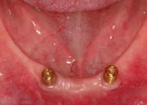 two dental implants for dentures 600x429
