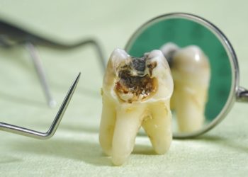 the consequences of failing to restore missing teeth 5d2a375aea448