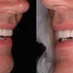 crowns and veneers case 1 result