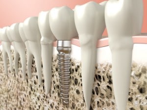 dental implants for the world congress on dental and oral health 5d554bfa2378f