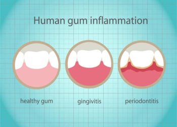 gum disease destroys smiles