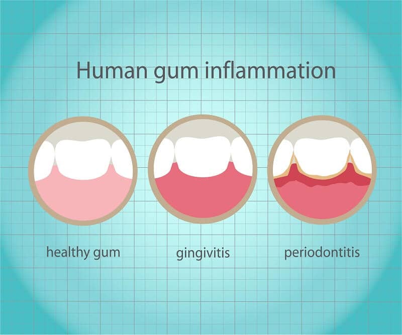 gum disease destroys smiles