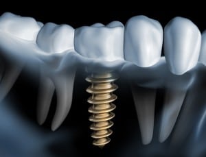 osseointegration the science behind dental implants 5d554bdd4bb1d