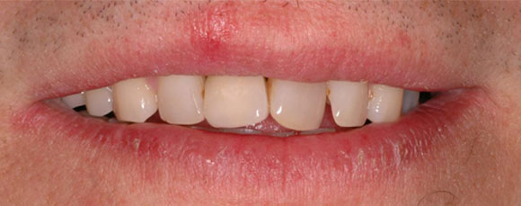 single tooth dental implants before and after
