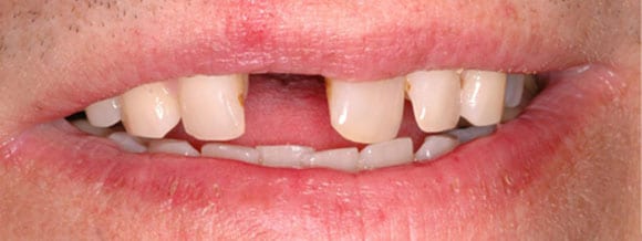 single tooth dental implants before and after