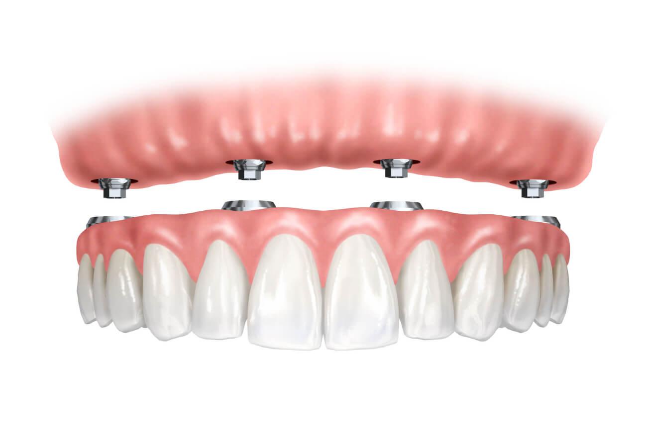 Illustration of Fixed Dentures