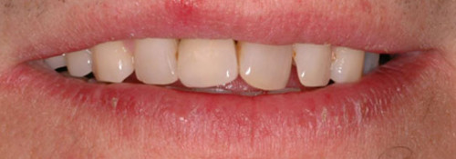 Single-Tooth Anterior Implant