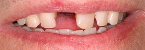 Single-Tooth Anterior Implant