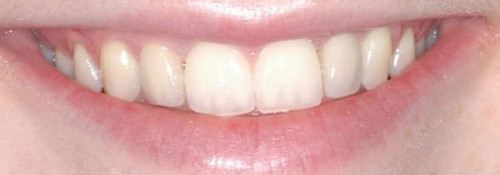 Multiple Teeth Front Implants