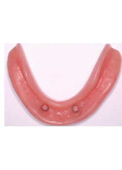 Two Implant Denture Support