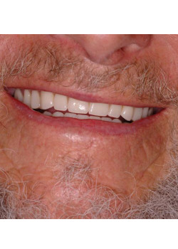 Three Implant Denture Support