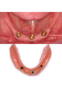 Three Implant Denture Support