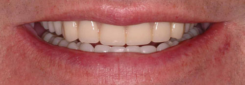 Milled Bar Overdenture