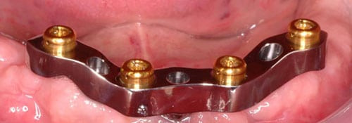 Milled Bar Overdenture