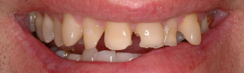 Crowns & Veneers Restoration