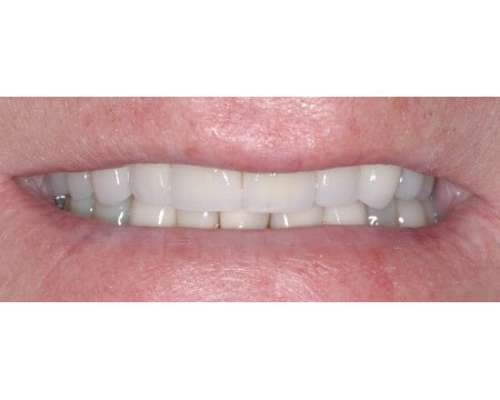 Worn & Misaligned Teeth