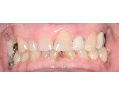 Worn & Misaligned Teeth