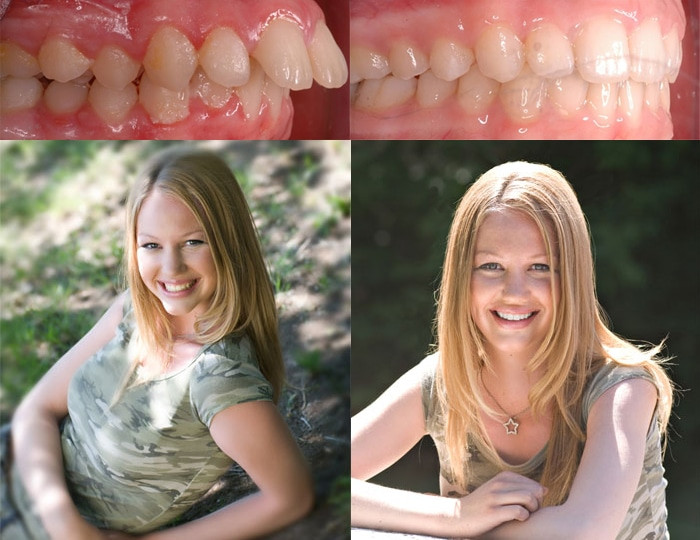 Fixed Overbite With Orthodontics