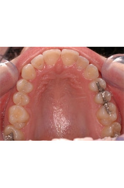 Fixed Crowding with Orthodontics