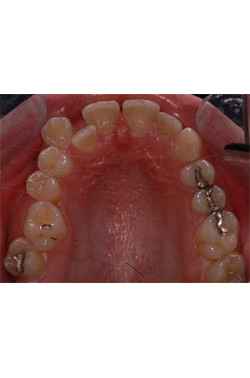 Fixed Crowding with Orthodontics