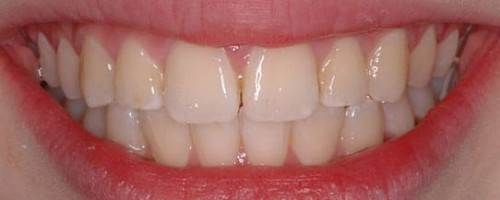 Orthodontics Treatment