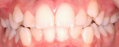 Orthodontics Treatment