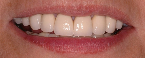 Crowns, Bonding, Veneers & Implants