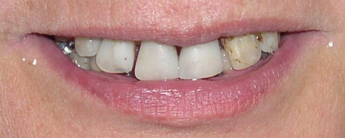 Crowns, Bonding, Veneers & Implants