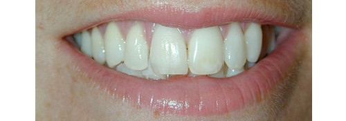 Zoom Whitening & Porcelain Crowns