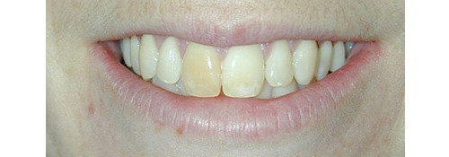 Zoom Whitening & Porcelain Crowns